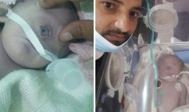 Viral Bayi Bermata Satu Lahir di Yaman, Pertanda Dajal?
