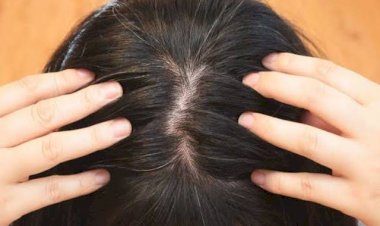 Akibat Stres Bisa Timbulkan Rambut Uban?