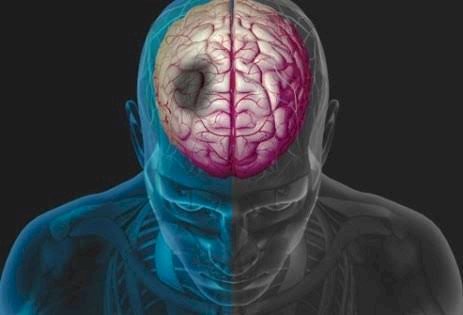 Kebiasaan yang Jadi Faktor Terserang  Stroke