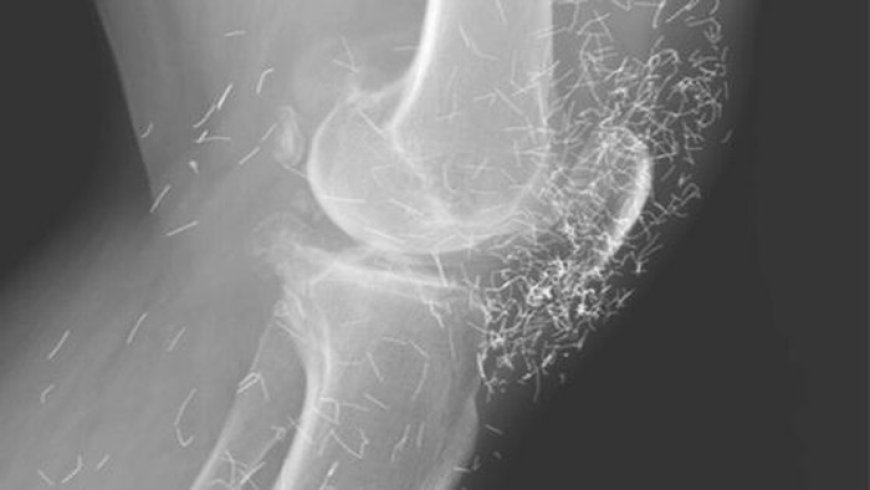 X-Ray Bongkar Ratusan Benang Emas di Lutut Wanita Korea, Netizen Syok!